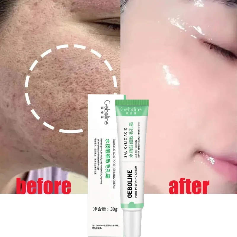 살리실산 모공 수축 크림, 빠른 제거, 큰 모공 제거, - Skincare Salicylic Acid 리뷰 및 가격