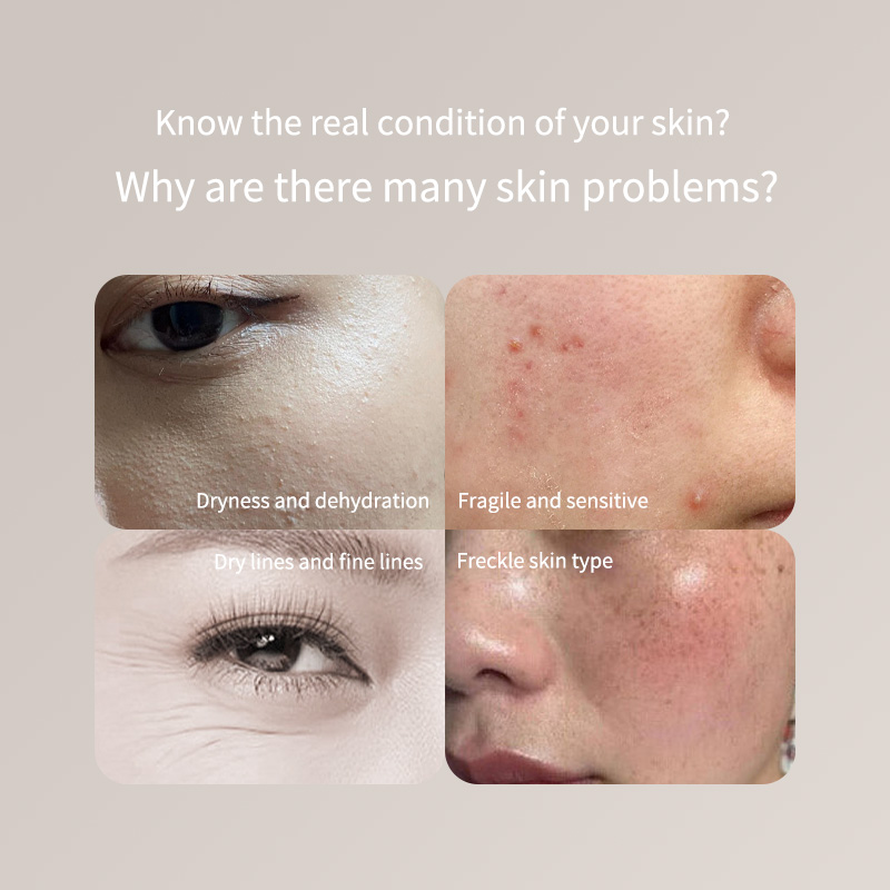 휴대용 피부 테스트 펜 - 얼굴 및 몸 전용 정확한 수 - Skincare Only You 리뷰 및 가격